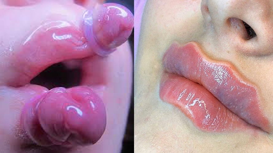 ¡Lo último de la moda viral: los "labios de pulpo”! | Virales
