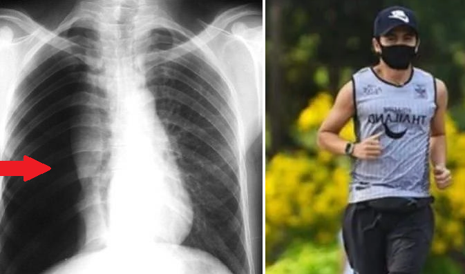 Salió a correr con tapabocas y le colapsó un pulmón | En el mundo