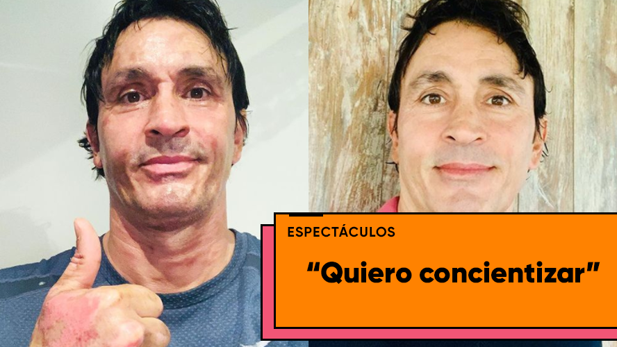 Sebastián Estevanez mostró las fotos de su rostro quemado | Espectáculos