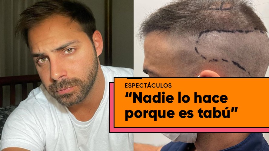 Grego Rossello se hizo un implante capilar y mostró los resultados | Espectáculos