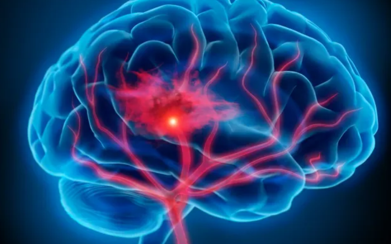 Qué es la afasia, la enfermedad que padece Bruce Willis | Salud