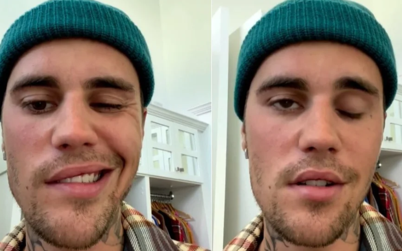 ¿Qué es síndrome de Ramsay Hunt? la enfermedad que padece Justin Bieber | Espectáculos