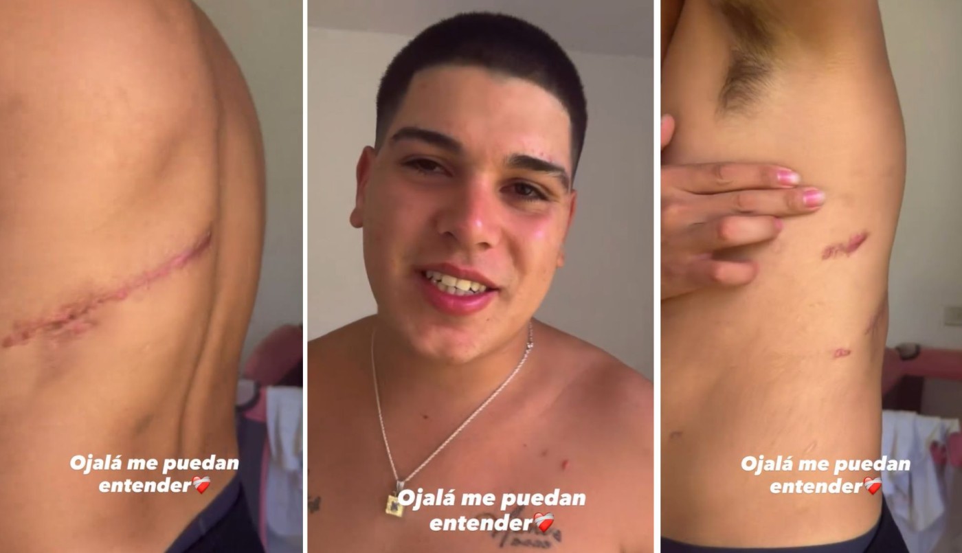 Thiago Medina mostró las secuelas del grave accidente que casi le cuesta la vida: "Tengo complejo con mis cicatrices" | Espectáculos