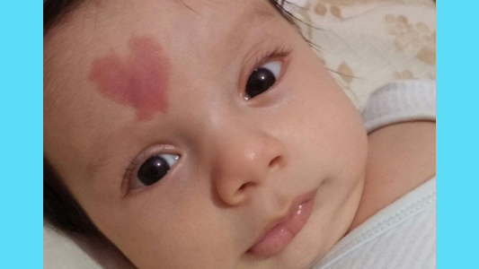 ¡Sorprendente! Mirá al bebé que tiene en la frente una mancha con forma de corazón