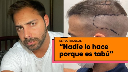 Grego Rossello se hizo un implante capilar y mostró los resultados
