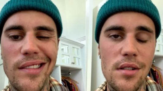 ¿Qué es síndrome de Ramsay Hunt? la enfermedad que padece Justin Bieber