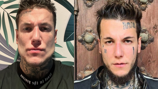 Alex Caniggia se hizo una operación en la mandíbula