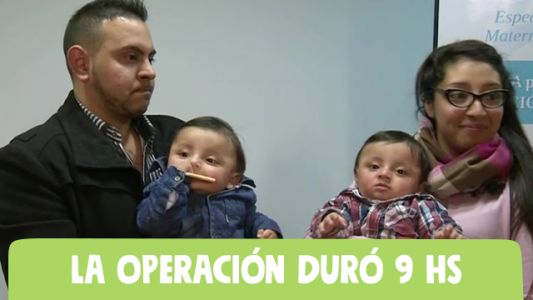 Inédita separación de siameses