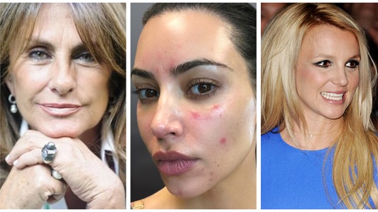 Las famosas que luchan contra la psoriasis