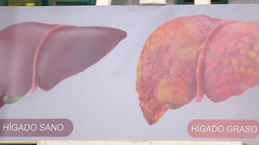 ¿Cómo prevenir el hígado graso?