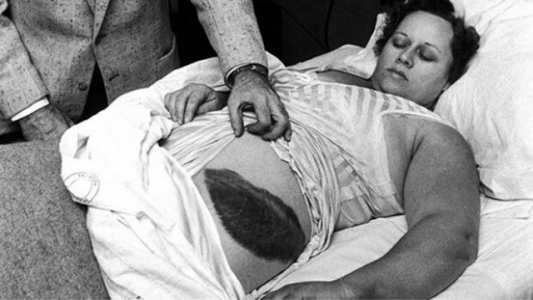 La historia de Ann Hodges, la única persona a la que le cayó un meteorito