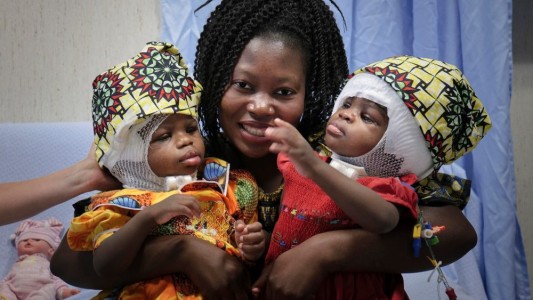 Operación exitosa: lograron separar a siamesas unidas por la cabeza