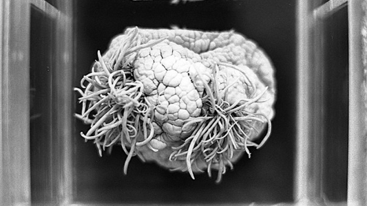 Le dolía la cabeza y descubrieron que tenía larvas en el cerebro