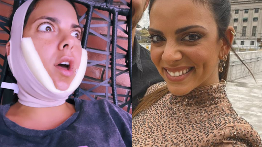 Belu Lucius se operó la “papada” y contó sus razones