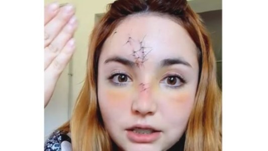 Una joven recibió un botellazo en el boliche: le tuvieron que coser la cara