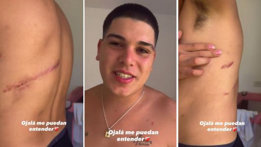 Thiago Medina mostró las secuelas del grave accidente que casi le cuesta la vida: "Tengo complejo con mis cicatrices"