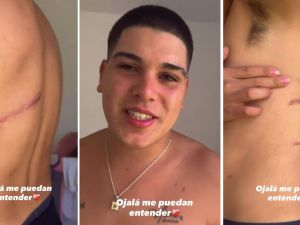 Thiago Medina mostró las secuelas del grave accidente que casi le cuesta la vida: "Tengo complejo con mis cicatrices"